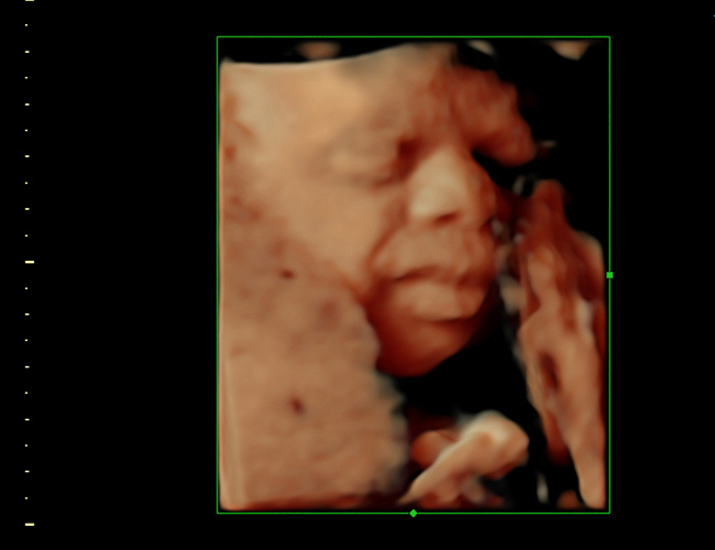3D ultrasound image at 28 weeks
